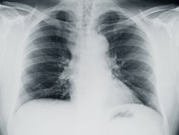 Pleural Mesothelioma