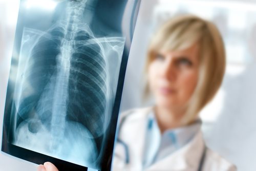 Stage III Mesothelioma