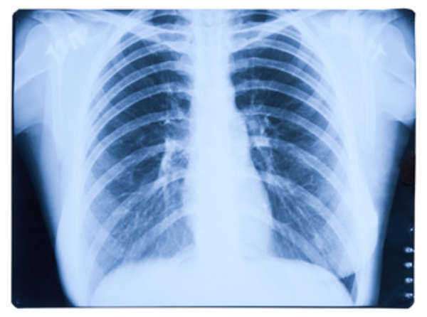 Benign Multicystic Mesothelioma